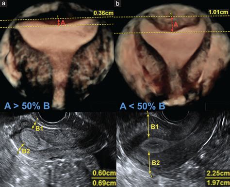 Diagnostic Rate And Accuracy Of The ESHREESGE Classification For