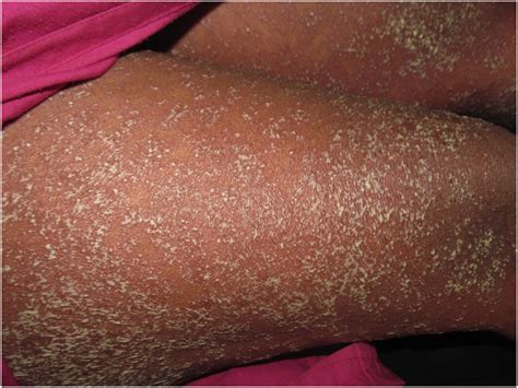 The Rash That Becomes An Erythroderma Clinics In Dermatology