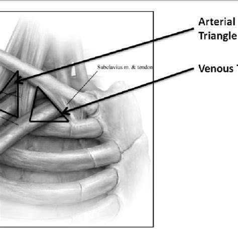 Pdf Venous Thoracic Outlet Syndrome