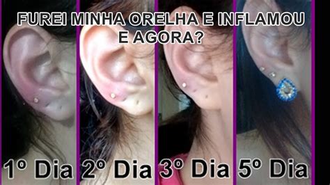 Como Tratar Queloide Na Orelha Piercing