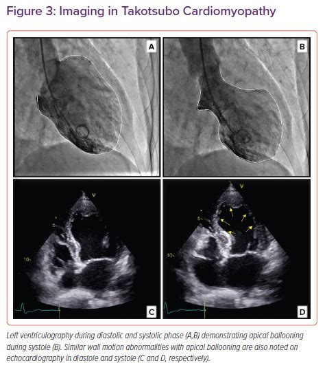 Imaging In Takotsubo Cardiomyopathy Radcliffe Cardiology