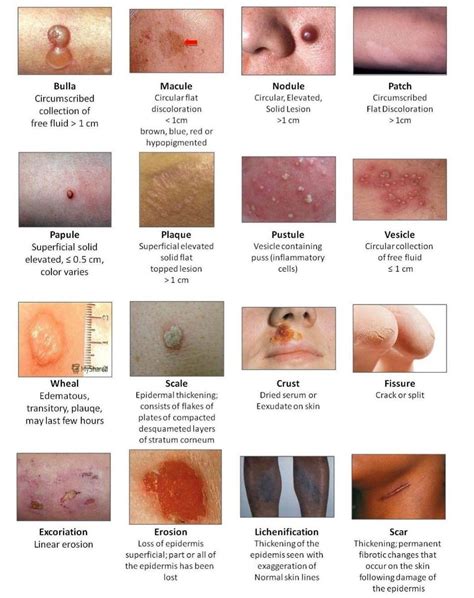 Skin Lesions MEDizzy