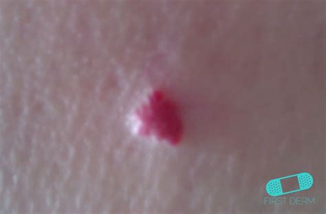 Online Dermatology - Angioma