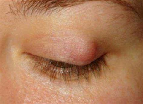 Eyelid Cyst: Symptoms, Causes and Treatment – EYExan.com