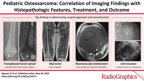 Pediatric Osteosarcoma Correlation Of Imaging Findings With