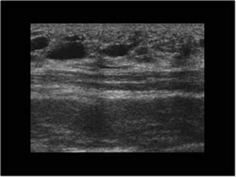 Thorax 8 4 Thoracic Wall Case 8 4 5 Benign Soft Tissue Lesions And Various Ultrasound Cases