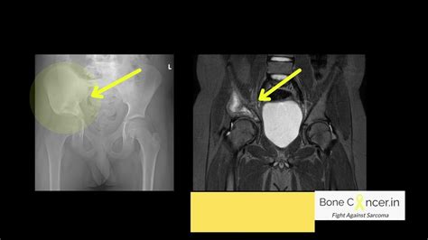 Treatment Of Bone Cancerewings Sarcomapelvis Hemipelvectomy Limb Salvage Surgery Dr