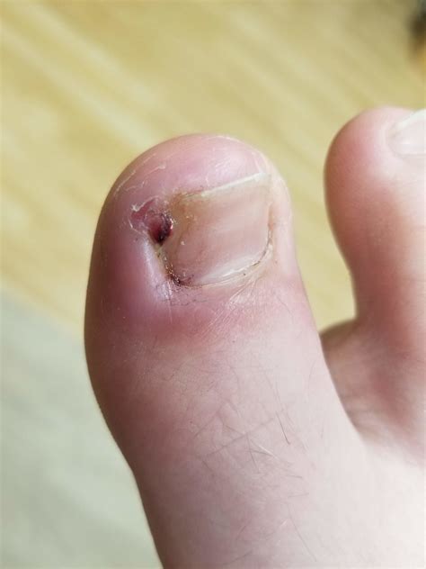 Ingrown Toenail Treatment Health First Southam Foot And Gait Clinic