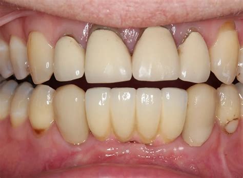 Case Prosthodontics Graystone Referral Centre Referrals In