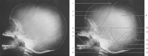 Skull | Radiology Key