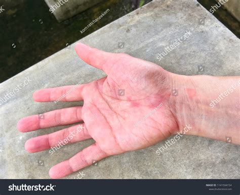 Lupus Rash On Hands