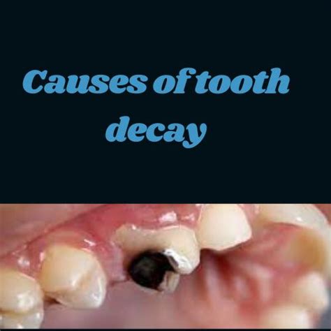 4 Causes of Tooth Decay in Uganda - TM Dental Solution