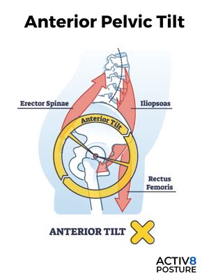 Anterior Pelvic Tilt Activ Posture