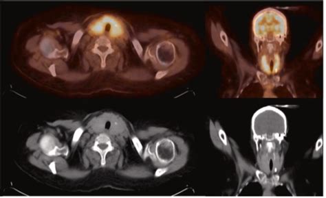 Characteristics Of Malignant Thyroid Lesions On Fdg Pet Ct Ssnmmi