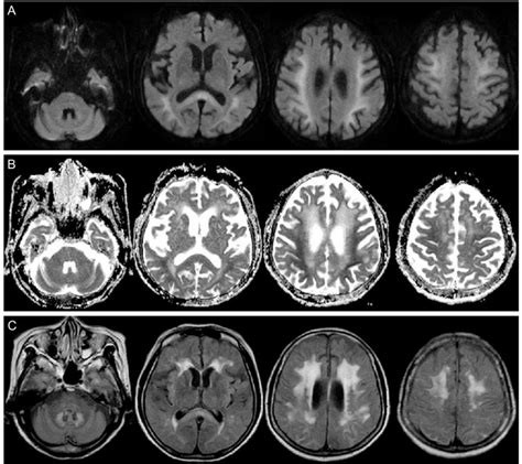 Follow Up Brain Magnetic Resonance Image Diffusion Weighted Imaging Download Scientific