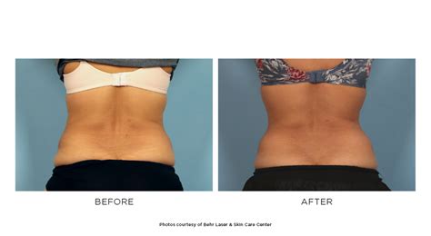 Coolsculpting® Fresno Ca Behr Laser And Skin Care Center