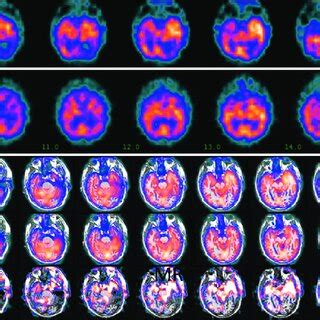 Single Photon Emission Computed Tomography SPECT Imaging And