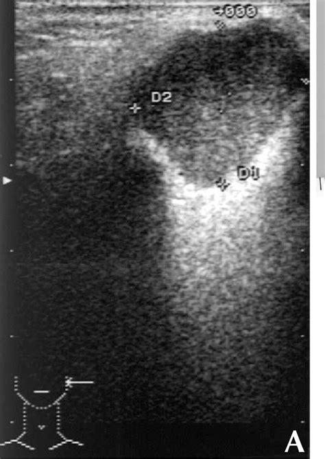 Figure 1 From Dermal Analogue Tumor Of The Salivary Gland Diagnosed By