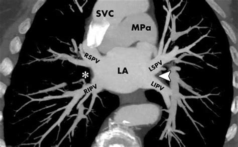 Comprehensive Cross Sectional Imaging Of The Pulmonary Veins