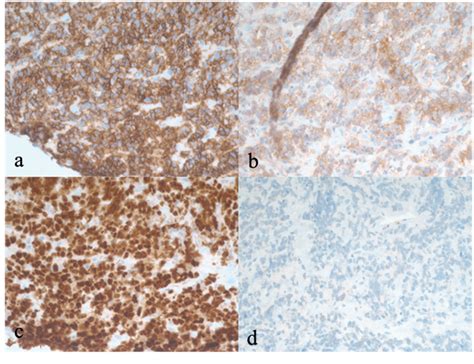 Figure 3 Immunohistochemical Staining Of The Patients Biopsy