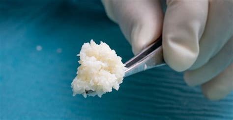 Kerecis Introduces New Easy To Use Fish Skin Graft