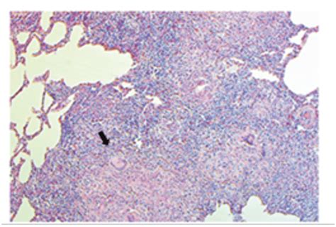 H E X Neumon A Granulomatosa Difusa Severa Granulomas En Donde Se