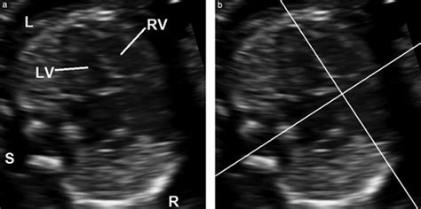 Changes In Fetal Cardiac Axis Between 8 And 15 Weeks Gestation