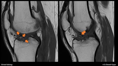 Ultimate Radiology Acl Avulsion Fracture