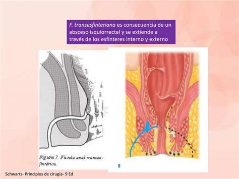 Abscesos Fistulas Anorectales Enfermedad Pilonidal Ppt