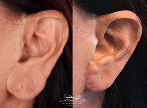 Earlobe Repair Appearance And Function Contour Dermatology