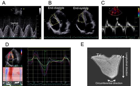 Clinical Significance Of Right Ventricular Function In Pulmonary