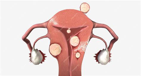 Premium Photo Uterine Fibroids Are Benign Growths Of Tissue In The Uterus