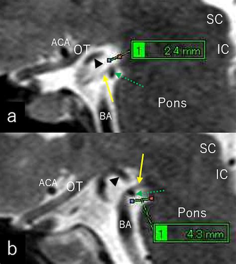 Sagittal T2 Weighted Magnetic Resonance Images Of Different Patient