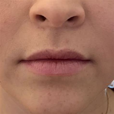 Dermal Fillers In Frisco TX Lip Fillers Fine Line