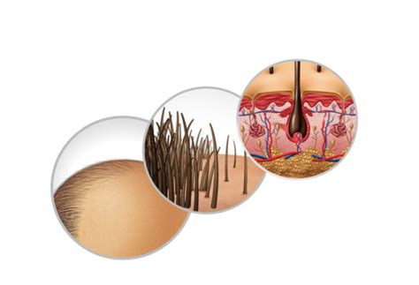 Foliculitis Causas Y Tratamientos Grupo Carpio