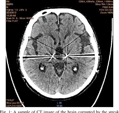 Figure 1 From Localization Of Deep Brain Stimulation Electrodes Via Metal Artifacts In Ct Images