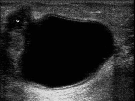 Atypical Image Findings In A Primary Subcutaneous Hydatid Cyst In The Gluteal Area Radiography