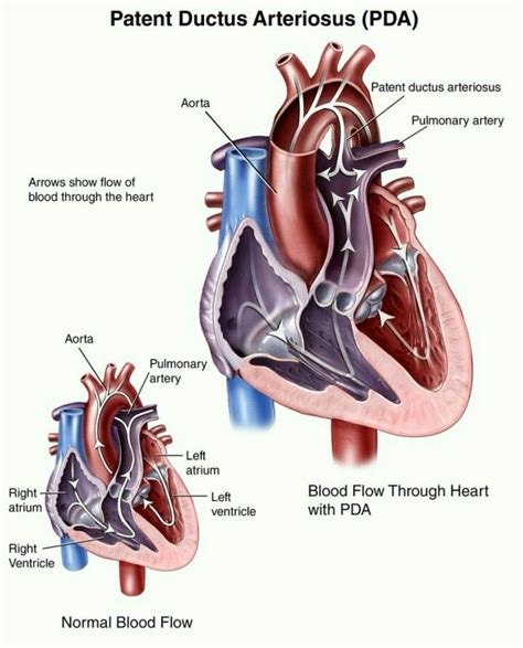 Patent Ductus Arteriosus Pda Patent Ductus Arteriosus Ductus