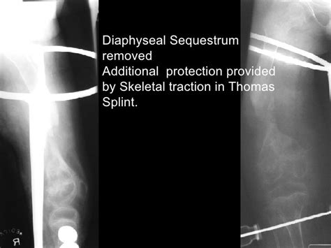 Diaphyseal Sequestrum