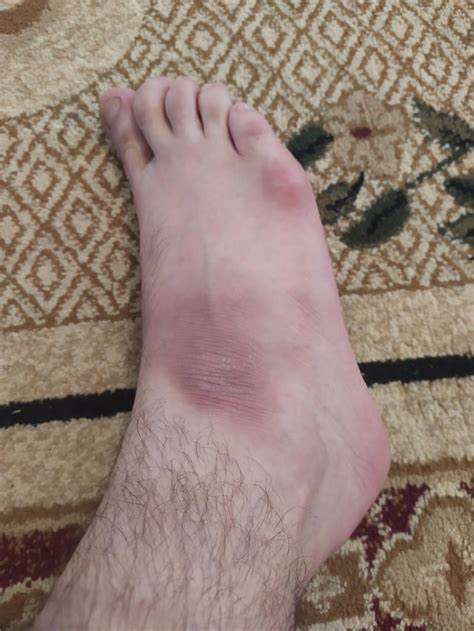 Hashimotos And Skin Issues Rhashimotos