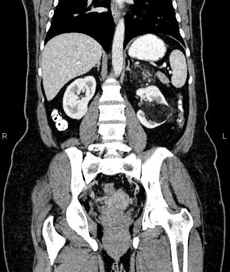 Renal Angiomyolipoma Image