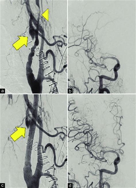 Right Common Carotid Angiography Before And After Carotid Artery Download Scientific Diagram