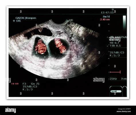 Pregnant Woman Ultrasound