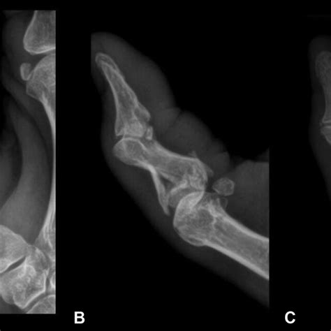 Preoperative Hand X Raysda Posteroanterior B Oblique And C Lateral