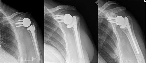 Best Orthopedic Hospital In Ahmedabad Reverse Shoulder Replacement Surgery