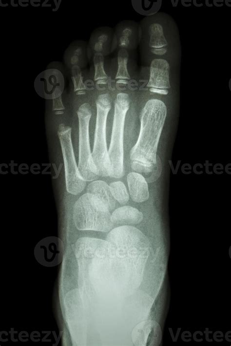 Normal Pediatric Ankle Xray