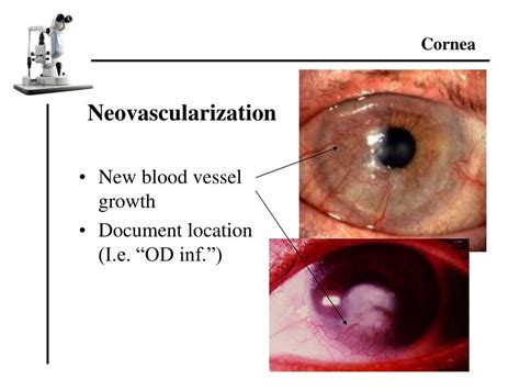 PPT - Slit Lamp Exam Findings PowerPoint Presentation, free download ...