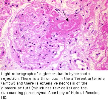 Renal Transplantation Flashcards Quizlet