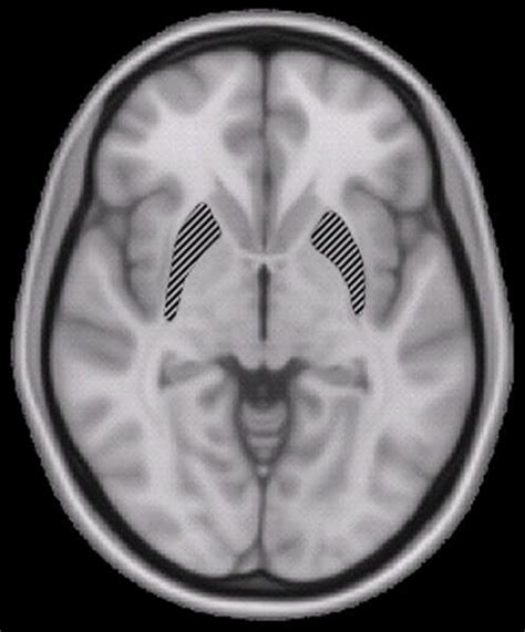 Bizarre Brain Problem, Pseudotumor Cerebri, From Antibiotics ...