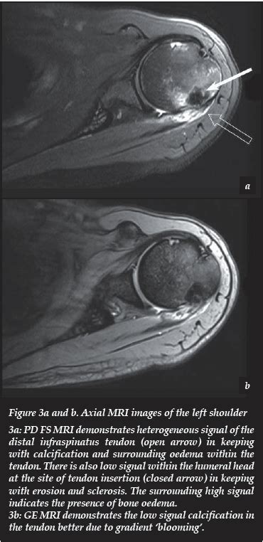 Intra Osseous Calcifying Tendinitis Of The Infraspinatus Tendon With